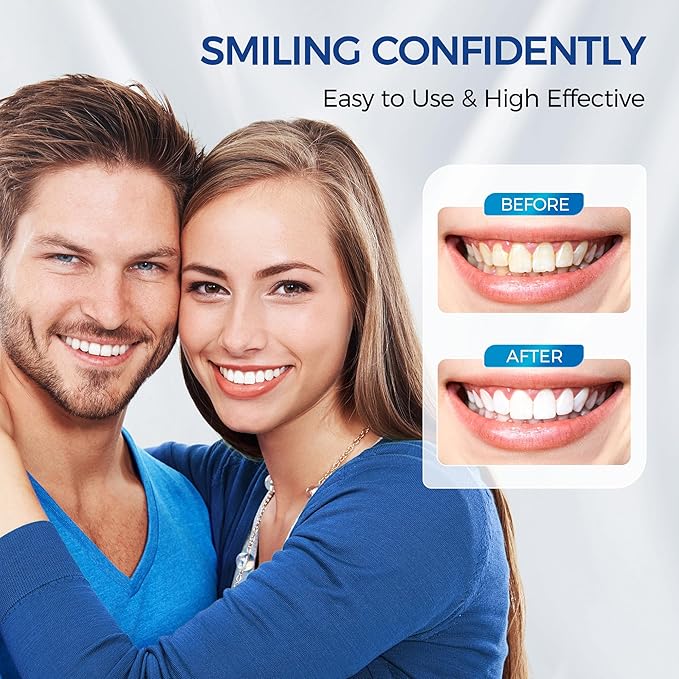 5 x Teeth Whitening Gel (4+1 Desensitizing Gel), No Sensitivity Teeth Whitening Gel Kit, Effective Teeth Whitener, Travel-Friendly Tooth Whitening Pen, Carbamide Peroxide Tooth Bleaching